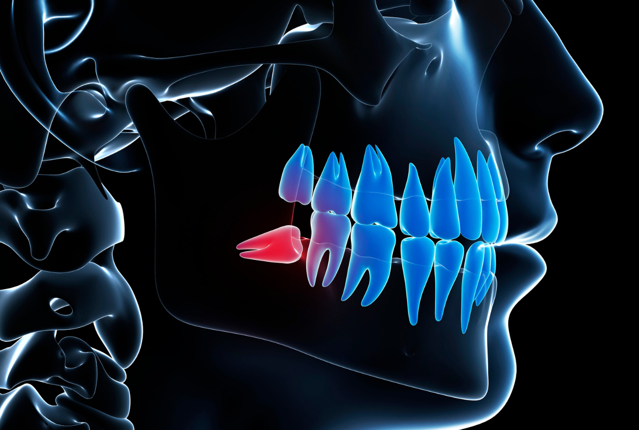 rimozione-denti-del-giudizio-storti