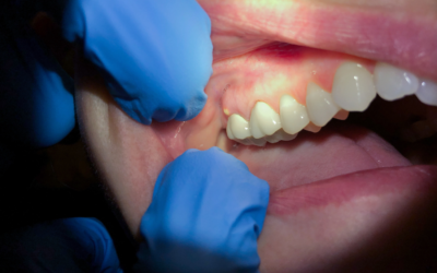 Ascesso dentale: perché compare e cosa fare