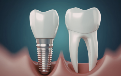 Capsule dentali (corone): quando servono e quanto durano